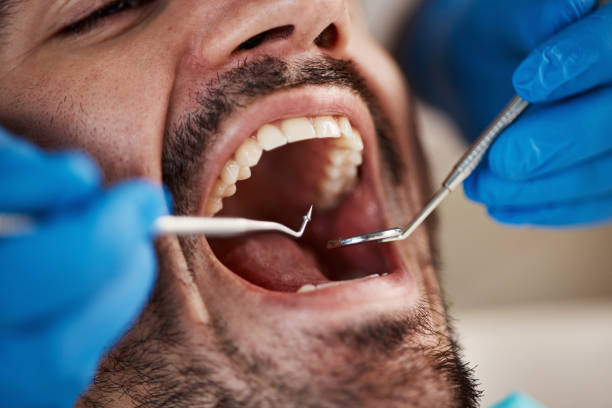 Best Knocked-Out Tooth (Avulsed Tooth) Treatment in Greenfield, MN